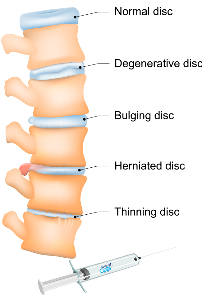 degenerative disc stem cell treatment, degenerative disc disease, stem cell therapy for degenerative disc,